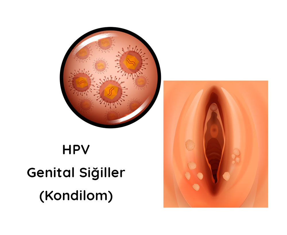 Helminthiasis tünetei és kezelése, Erkeklerde humán papilloma vírus tedavisi